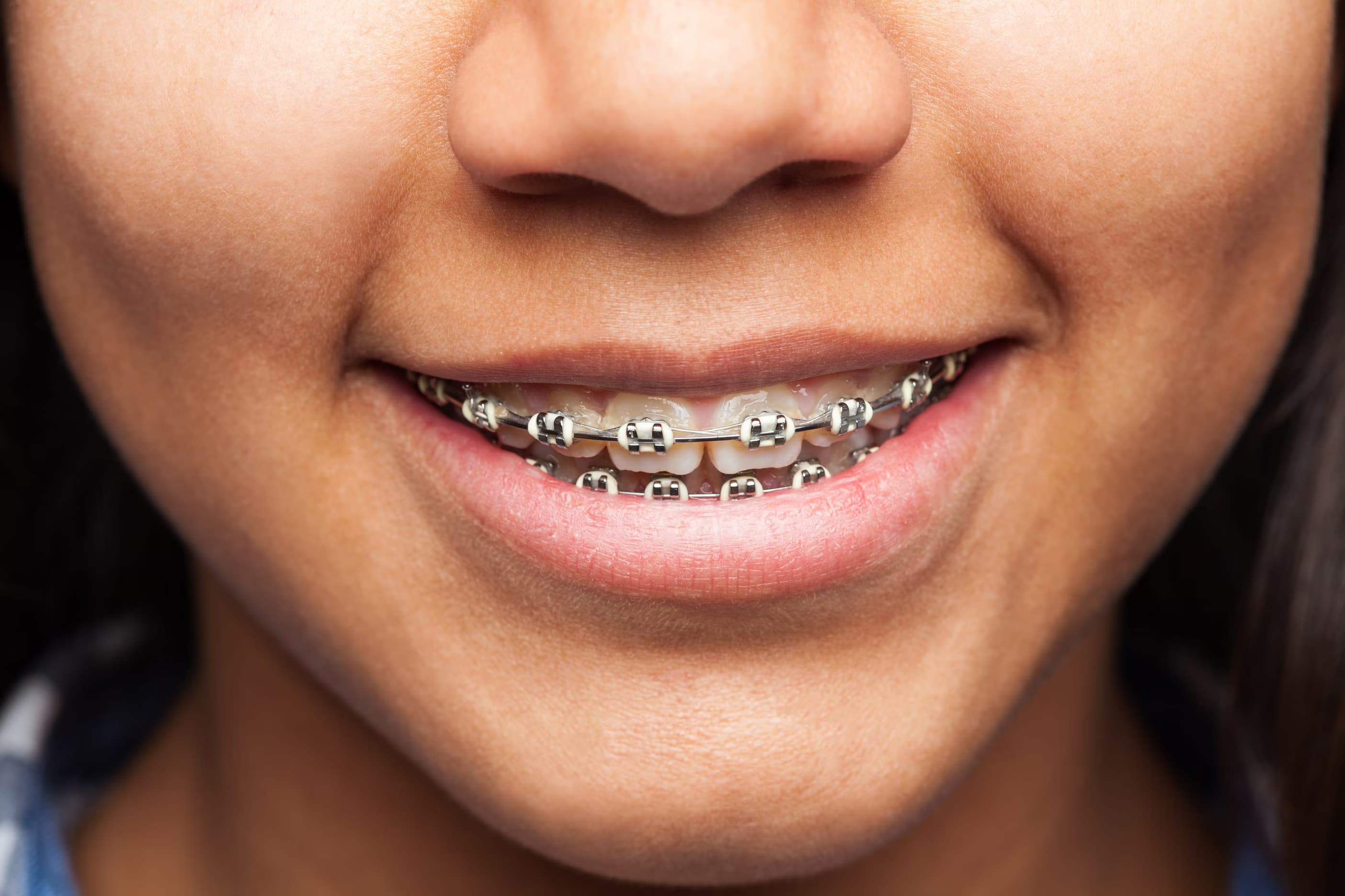 Orthodontics at Green Valley Dental in Fairfield, CA