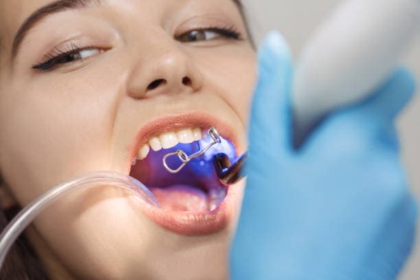 Bonding at Green Valley Dental in Fairfield, CA