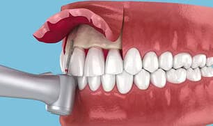 Crown Lengthening at Green Valley Dental in Fairfield, CA