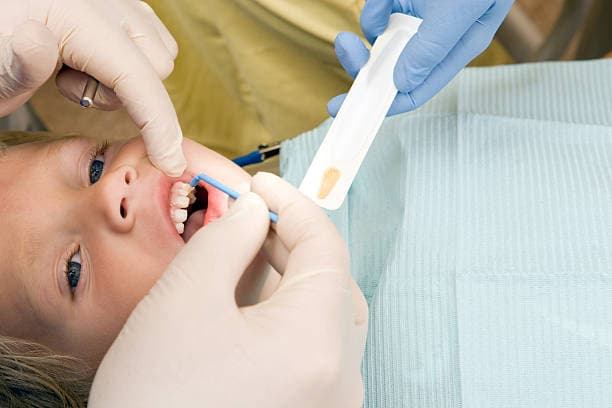 Fluoride Treatments at Green Valley Dental in Fairfield, CA