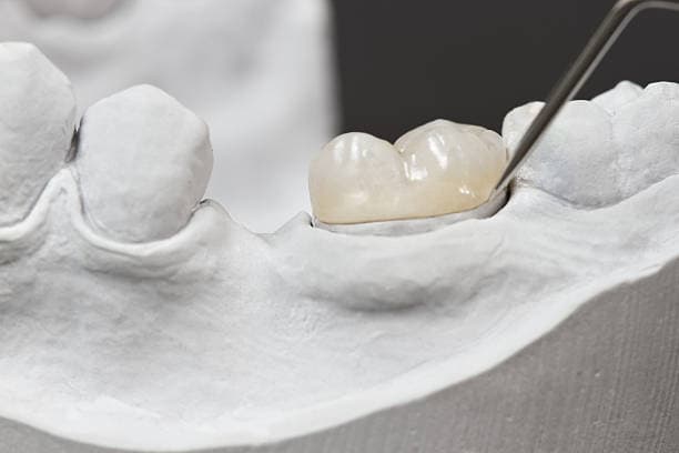 Inlays & Onlays at Green Valley Dental in Fairfield, CA