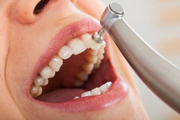 Teeth Cleanings at Green Valley Dental in Fairfield, CA