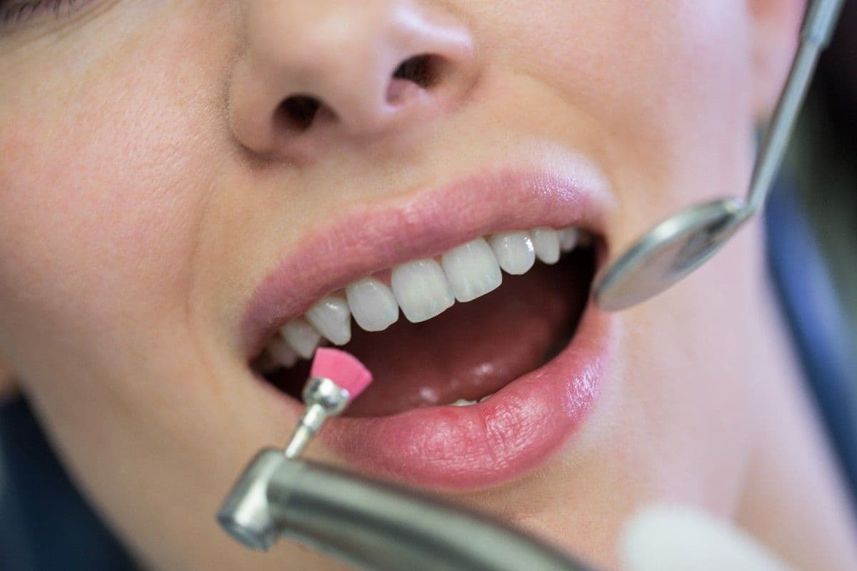 Veneers at Green Valley Dental in Fairfield, CA